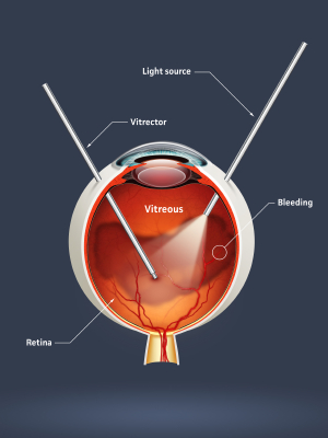 High quality raster illustration of retinal detachment with clipping path.