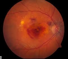 Wet Age related macular degeneration